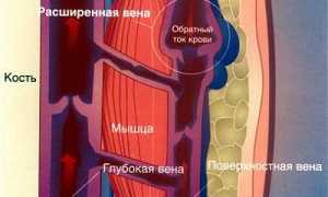Лечение варикозного расширения вен на ногах: эффективные методы и советы