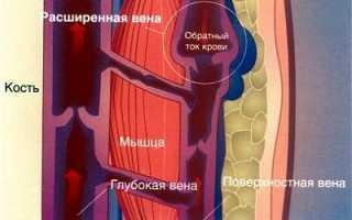 Лечение варикозного расширения вен на ногах: эффективные методы и советы