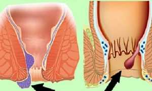 Из-за чего у девушек появляется геморрой?