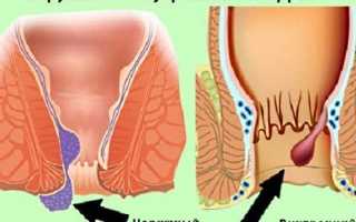 Из-за чего у девушек появляется геморрой?
