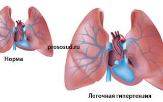 Лечение и признаки легочной гипертензии: важные аспекты здоровья