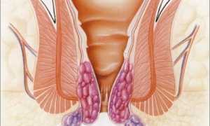 Применение физиопроцедур при лечении геморроя в больнице и домашних условиях
