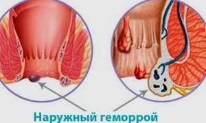 Возникновение наружного геморроя во время беременности — как бороться?