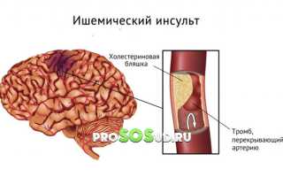 Как вовремя предупредить инсульт и сохранить здоровье