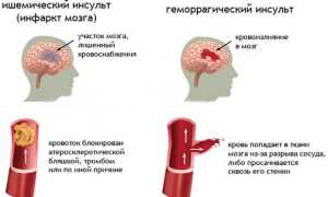 Симптомы и последствия повторного инсульта, что предпринять для профилактики и восстановления