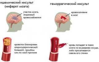 Симптомы и последствия повторного инсульта, что предпринять для профилактики и восстановления