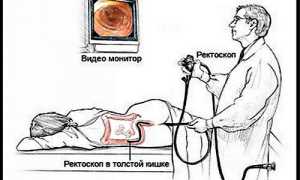 Как подготовиться к ректороманоскопии в домашних условиях и как проводится процедура?