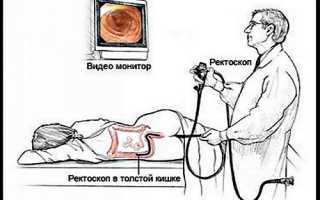 Как подготовиться к ректороманоскопии в домашних условиях и как проводится процедура?