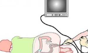 Что такое колоноскопия?