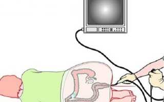 Что такое колоноскопия?