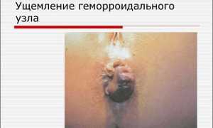 Что такое ущемленный геморроидальный узел и как его лечить?