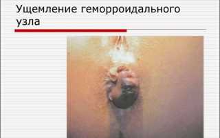 Что такое ущемленный геморроидальный узел и как его лечить?