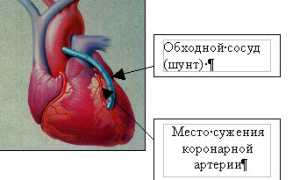 Шунтирование сосудов сердца: методы и преимущества