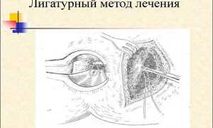 Хирургическое лечение парапроктита