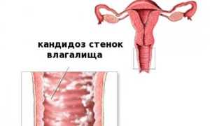 Бывает ли одновременно и геморрой, и молочница?