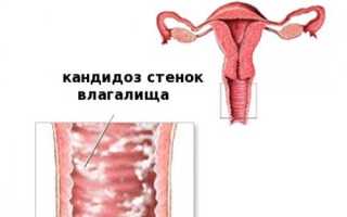 Бывает ли одновременно и геморрой, и молочница?