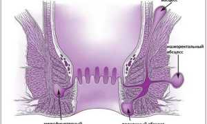 Симптомы парапроктита и методы лечения заболевания