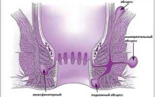 Симптомы парапроктита и методы лечения заболевания