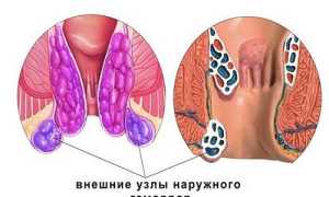 Что делать, если обострился геморрой? Первая помощь в домашних условиях