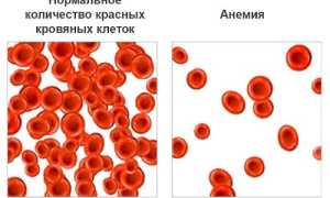 Причины и симптоматика постгеморрагической анемии?