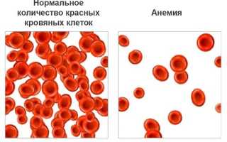 Причины и симптоматика постгеморрагической анемии?