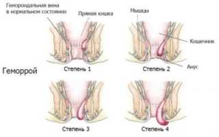 Геморрой — причины, типы, степени развития, симптомы, лечение и профилактика