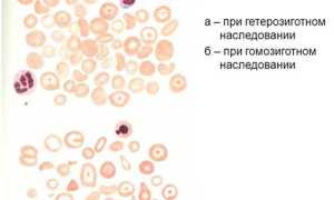 Талассемия: что за болезнь, откуда берется и как с ней жить
