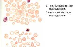 Талассемия: что за болезнь, откуда берется и как с ней жить
