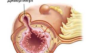 Как лечить дивертикулез кишечника?