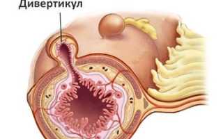 Симптомы и лечение дивертикулита кишечника