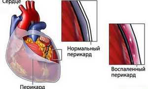 Опасный ревмокардит: причины, симптоматика, пути лечения и профилактика