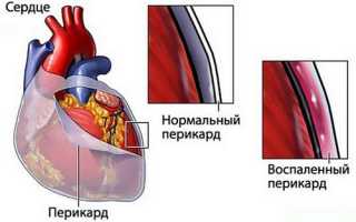Опасный ревмокардит: причины, симптоматика, пути лечения и профилактика