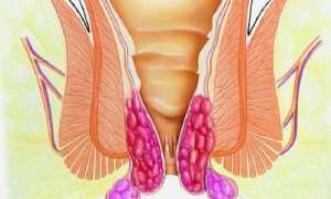 Что такое геморроидальные узлы?