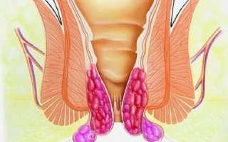 Что такое геморроидальные узлы?