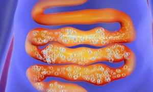 Как избавиться от метеоризма при геморрое?