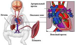 Опасно ли открытое овальное окно в сердце у ребенка для его здоровья?