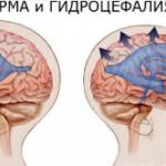 Норма и гидроцефалия головного мозга