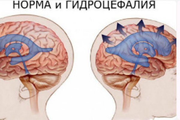 Норма и гидроцефалия головного мозга