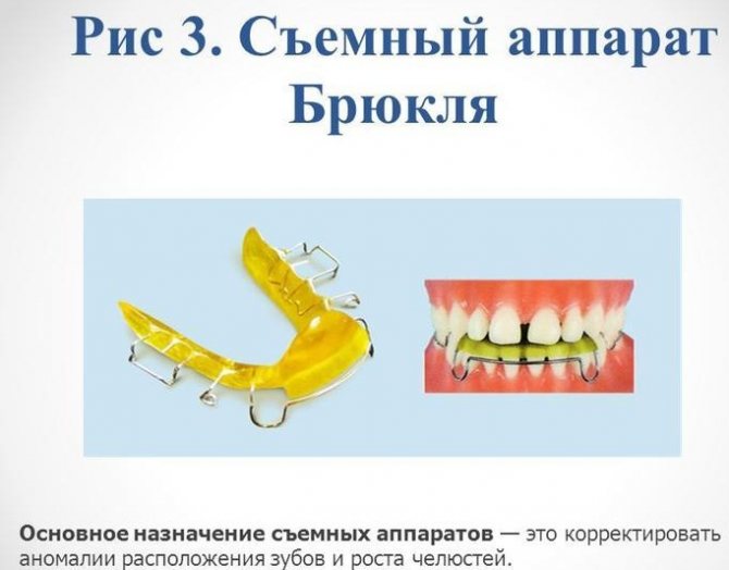 Ортодонтическая пластинка для детей. Классификация и виды, цены