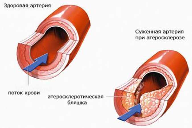 бляшка