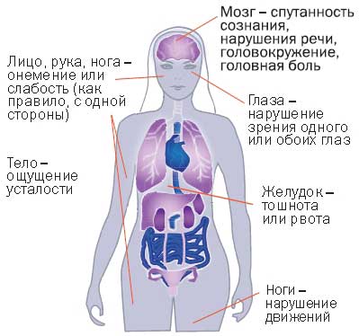 симпмтомы инсульта