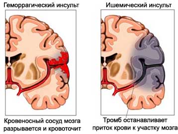 кровеносный сосуд мозга