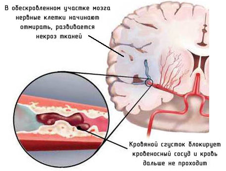 сгусток в артерии