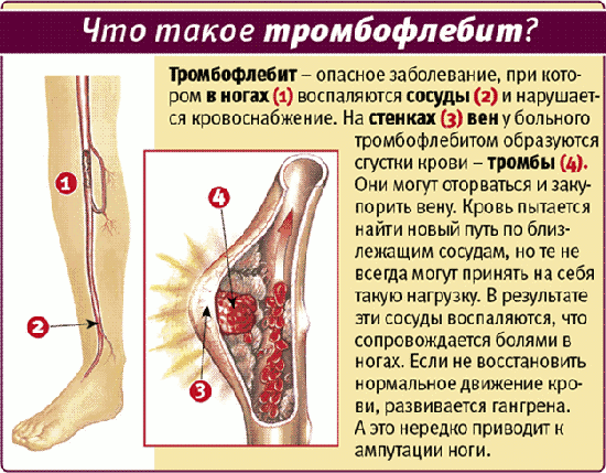 как проявляется тромбофлебит