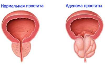 аденома простаты