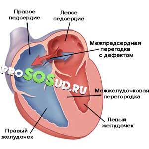 аневризма сердца у детей