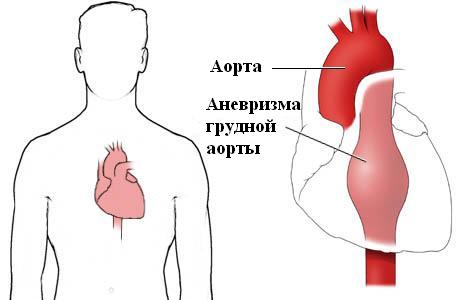 грудная аорта