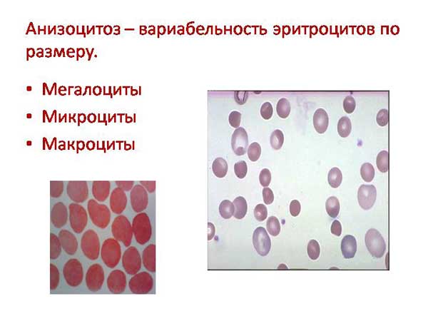  анизоцитоз