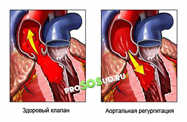 аортальная недостаточность