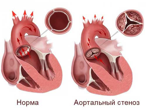 стеноз аортального клапана